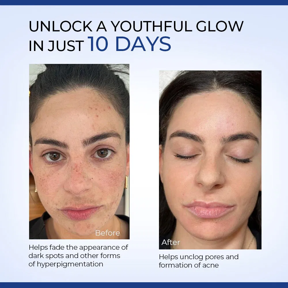 Suero facial de ácido glicólico tratamiento para el acné removedor de manchas oscuras suero facial iluminador