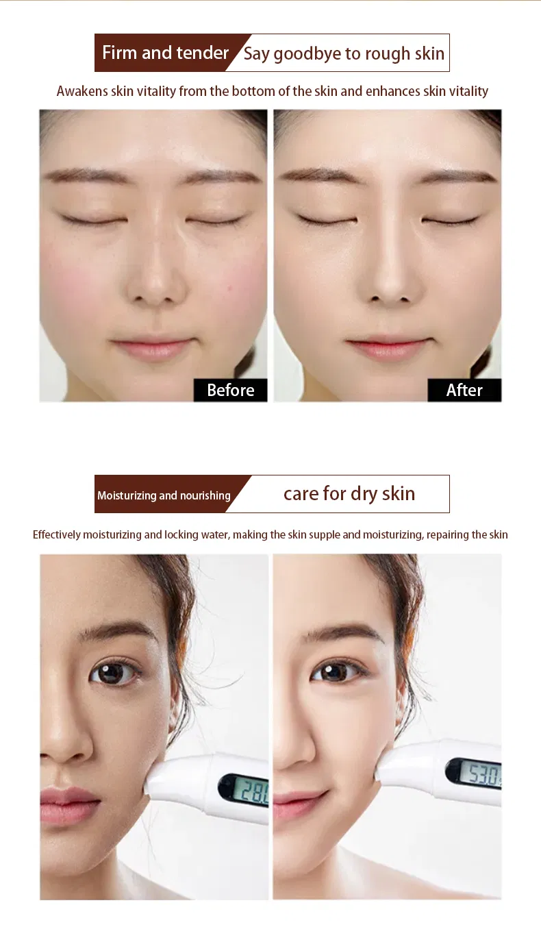 Tratamiento para el acné con ácido hialurónico, exfoliante, contracción de poros, restaurar la elasticidad de la piel, suero facial