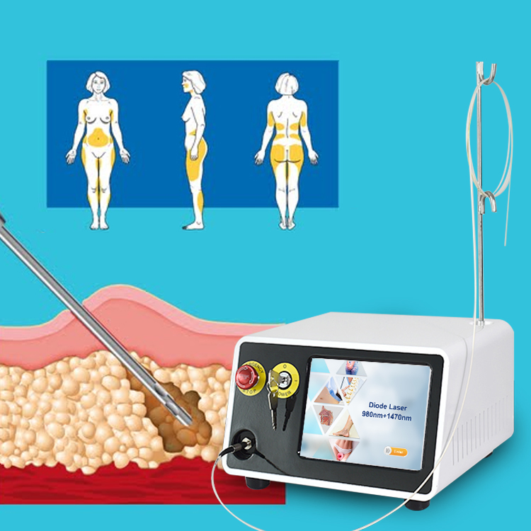 2023 Mejor Vendedor Profesional de Fibra Óptica para Lifting Facial y Lipólisis 1470nm Máquina de Láser Endo