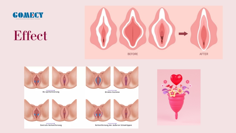 2025 Rejuvenecimiento Vaginal con Láser (LVR) 980nm 1470nm Cirugía de Rejuvenecimiento y Apretamiento Vaginal con Láser de Diodo, Mano de Láser