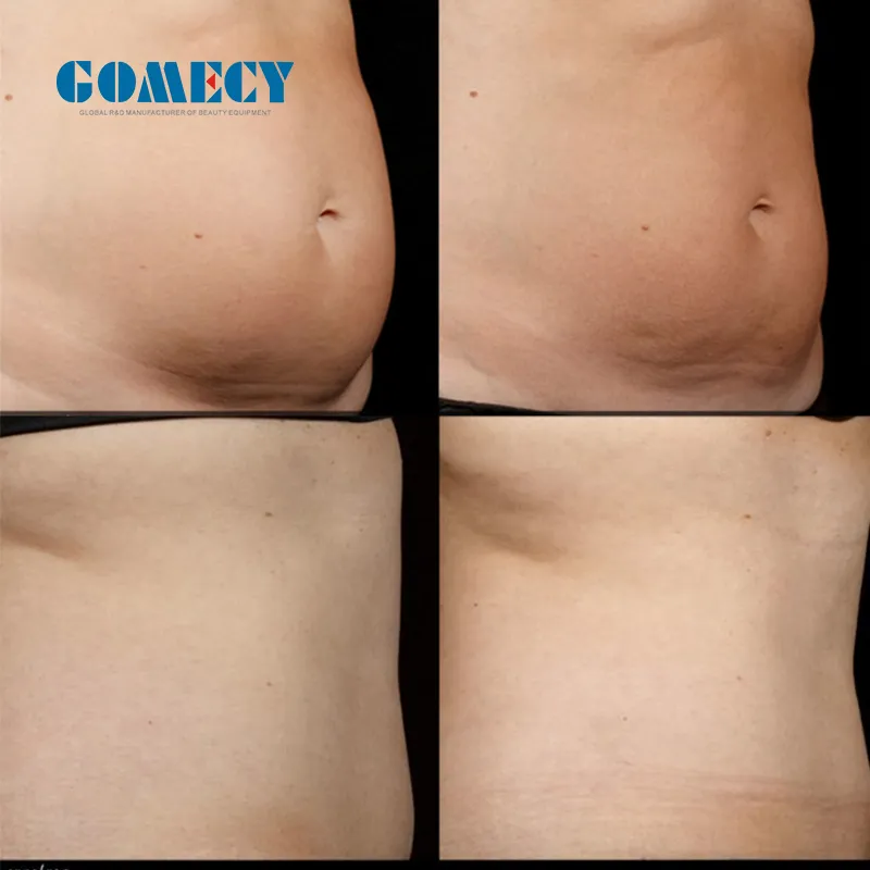 Antes y después lipólisis facial