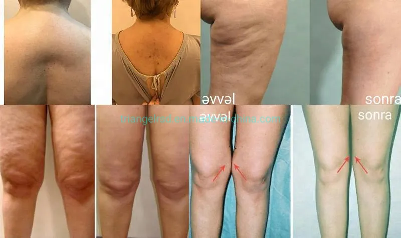Comparativa de efectos de lipólisis
