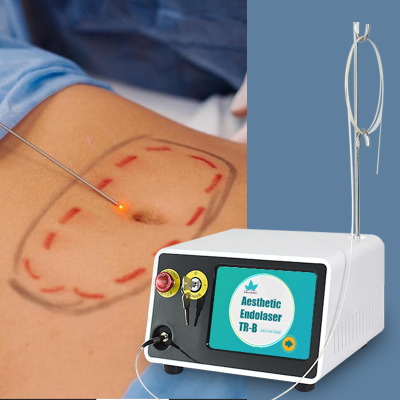 Dispositivo de Liposucción Láser Endolaser Triangel Más Nuevo 1470 980nm Elevación Facial