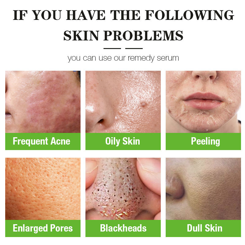 Productos de Cuidado de la Piel de Marca Privada Suero Antiinflamatorio Suero Hidratante Iluminador Reparador para el Rostro