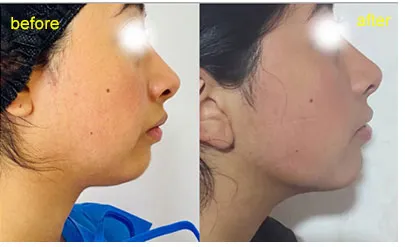Antes y después tratamiento de lifting facial láser