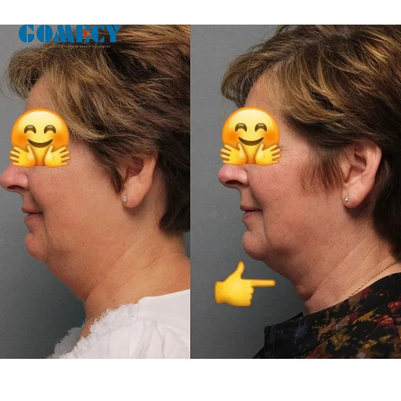 Máquina de Fibra Óptica de Doble Longitud de Onda Endoláser para Apretar la Piel Lipólisis para Lifting Facial Cánulas de Liposucción Diode 980nm 1470nm