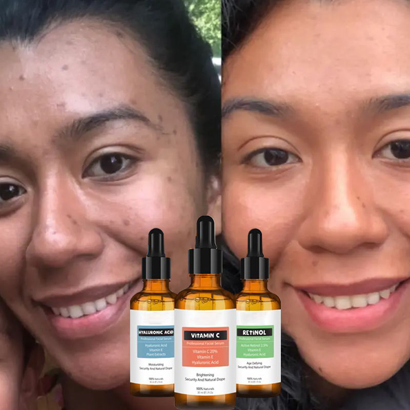 Nuevo Suero Blanqueador de Ácido Hialurónico, Retinol y Vitamina C