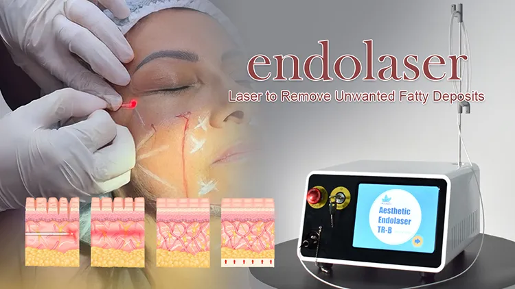 Dispositivo de Liposucción Láser Endolaser 1470 980nm Elevación Facial