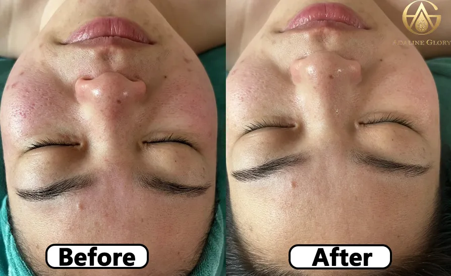 Precision Pigment Correction Bio-Microneedle Facial Kit Melasma Dark Spot Brightening Serum Repair Mask SPA Salon Wholesale OEM