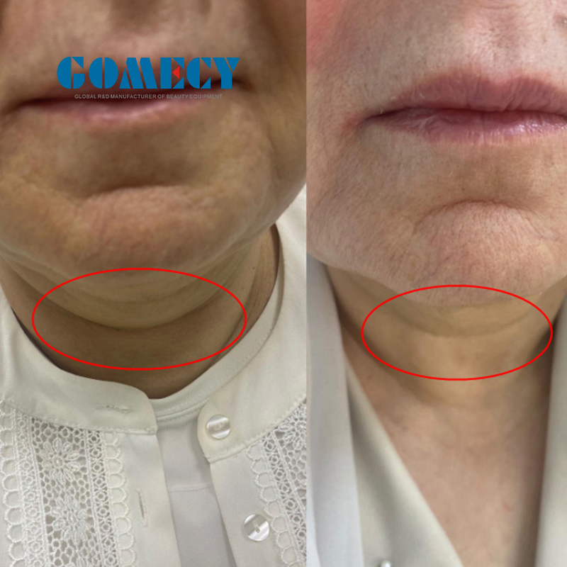 2024 Nuevo Lifting Facial con Láser de Fibra Óptica Profesional para Tensar la Piel 980nm 1470nm Máquina de Endoláser