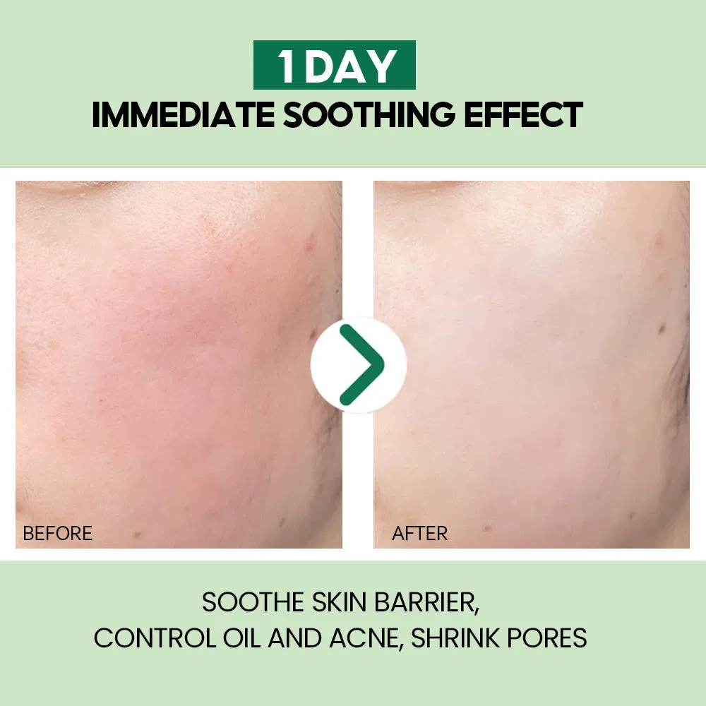 Suero facial orgánico calmante para el acné y anti-envejecimiento con aloe vera
