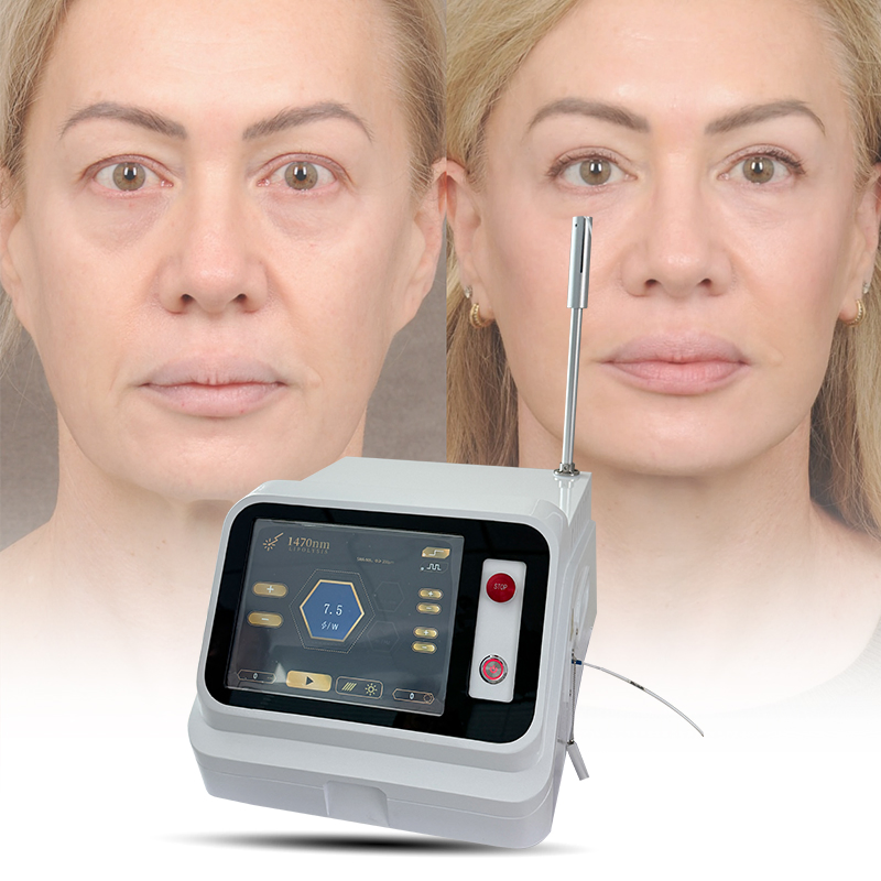 Cirugía Médica Láser 1470 Eliminación de Celulitis con Láser de Diodo Lipólisis Pérdida de Peso Esbeltez Corporal Cirugía de Liposucción