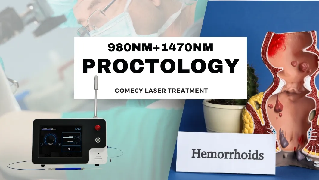 Equipo de láser Evlt/ Tratamiento Evlt Tratamiento de dolor en las venas de las piernas Clase 4 Láser en venta Variceslaser Endovascular PARA Varices Disolviendo grasas
