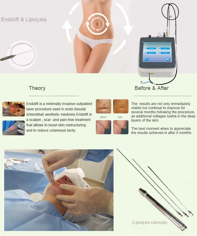 Máquina de Fibra Óptica de Doble Longitud de Onda Endoláser para Apretar la Piel Lipólisis para Lifting Facial Cánulas de Liposucción Diode 980nm 1470nm