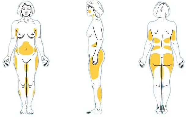 Cirugía Médica Láser 1470 Eliminación de Celulitis con Láser de Diodo Lipólisis Pérdida de Peso Esbeltez Corporal Cirugía de Liposucción