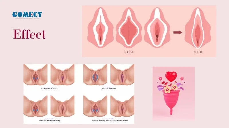 Tratamiento de Rejuvenecimiento Vaginal Láser