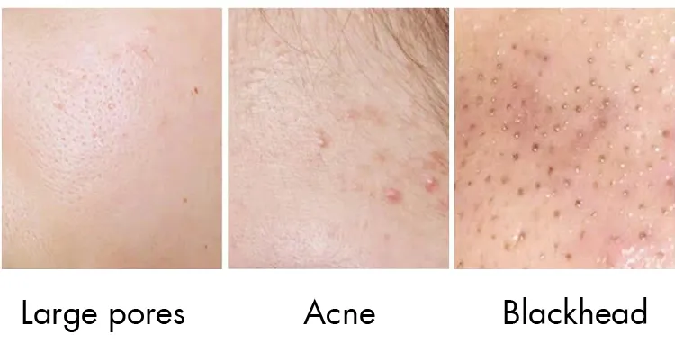 Suero Tratamiento Antiacné BHA Clear Skin para eliminar el acné, calmar la piel y reducir los poros