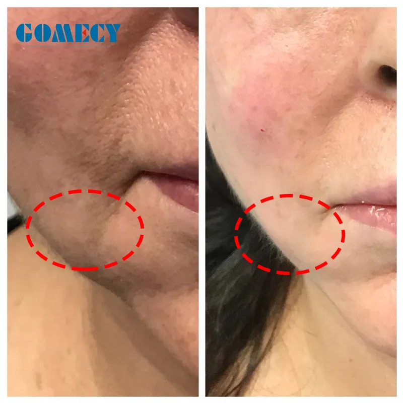 Antes y después tratamiento lifting facial