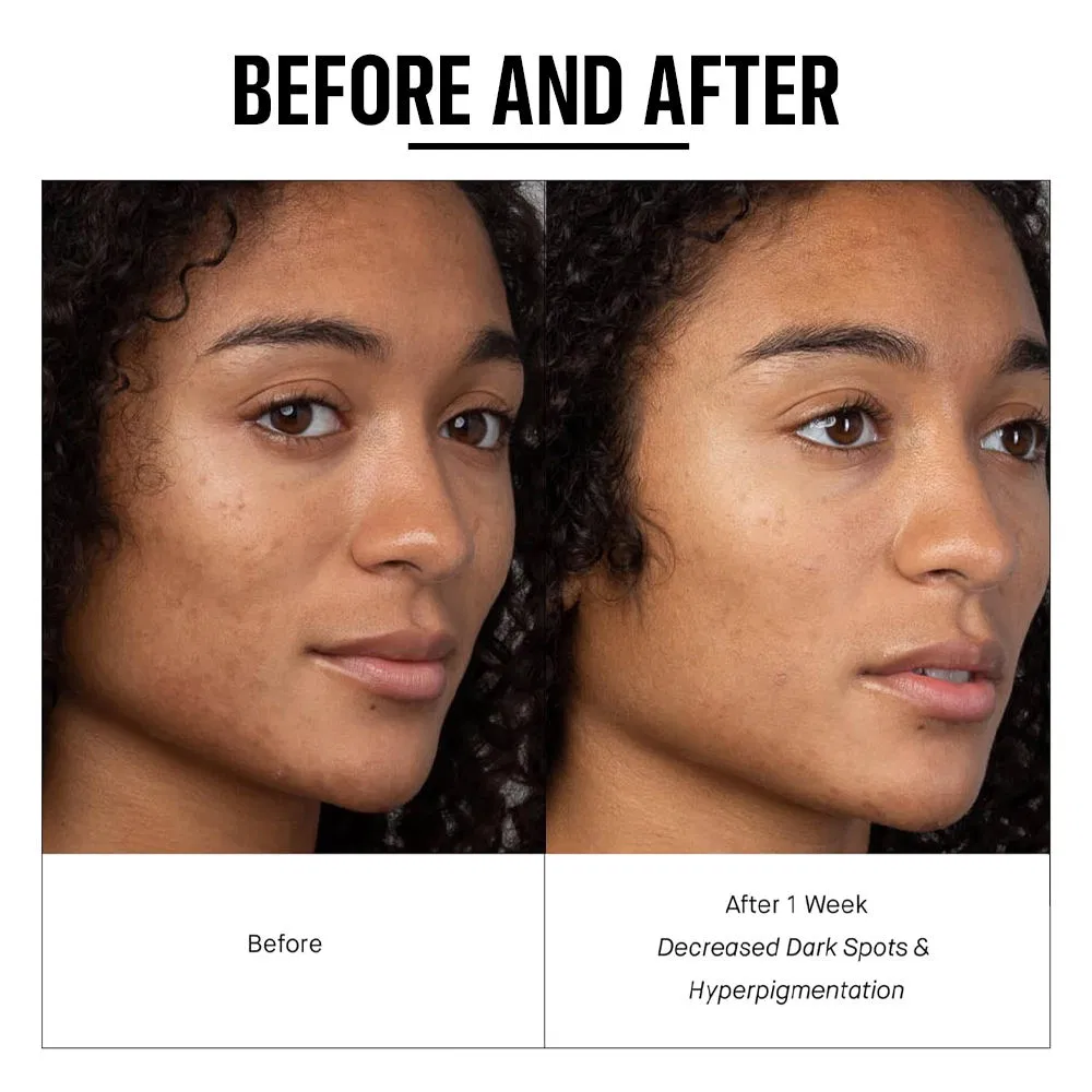Suero facial orgánico iluminador antiacné con ácido azelaico