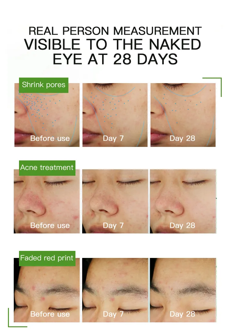 Suero Facial Exfoliante Anti Acné de Marca Privada 30ml Tratamiento Removedor Reparador de Piel Suero de Ácido Azelaico