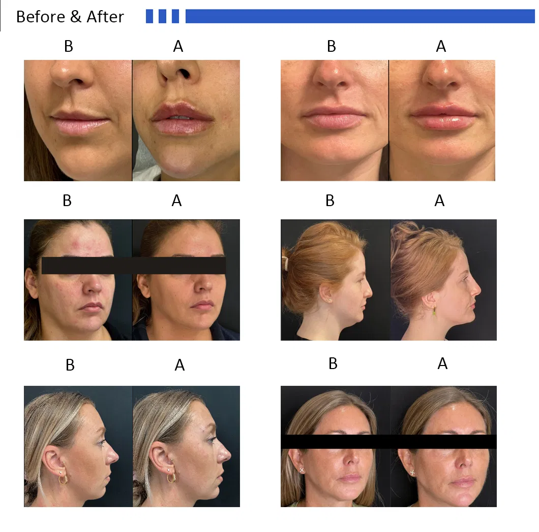 Etiqueta Privada OEM/ODM Ácido Hialurónico Rejuvenecedor de Piel Anti Envejecimiento Arrugas Inyección de Relleno Dermal para Labios Inyecciones de Rodilla