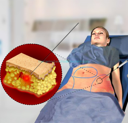 Nueva Tendencia 980nm Máquina Quirúrgica de Liposucción con Láser de Diodo Vaser Lipólisis con Láser