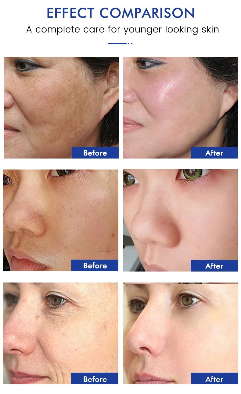 Suero para el cuidado de la piel de venta caliente Retinol Niacinamida Vitamina C Ácido Hialurónico Antienvejecimiento Alisante Reafirmante de la piel 5 en 1 Suero
