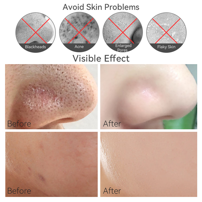 Blackhead Remover Device with Pore Vacuum Derma Suction Skin Rejuvenation and Acne Treatment Feature