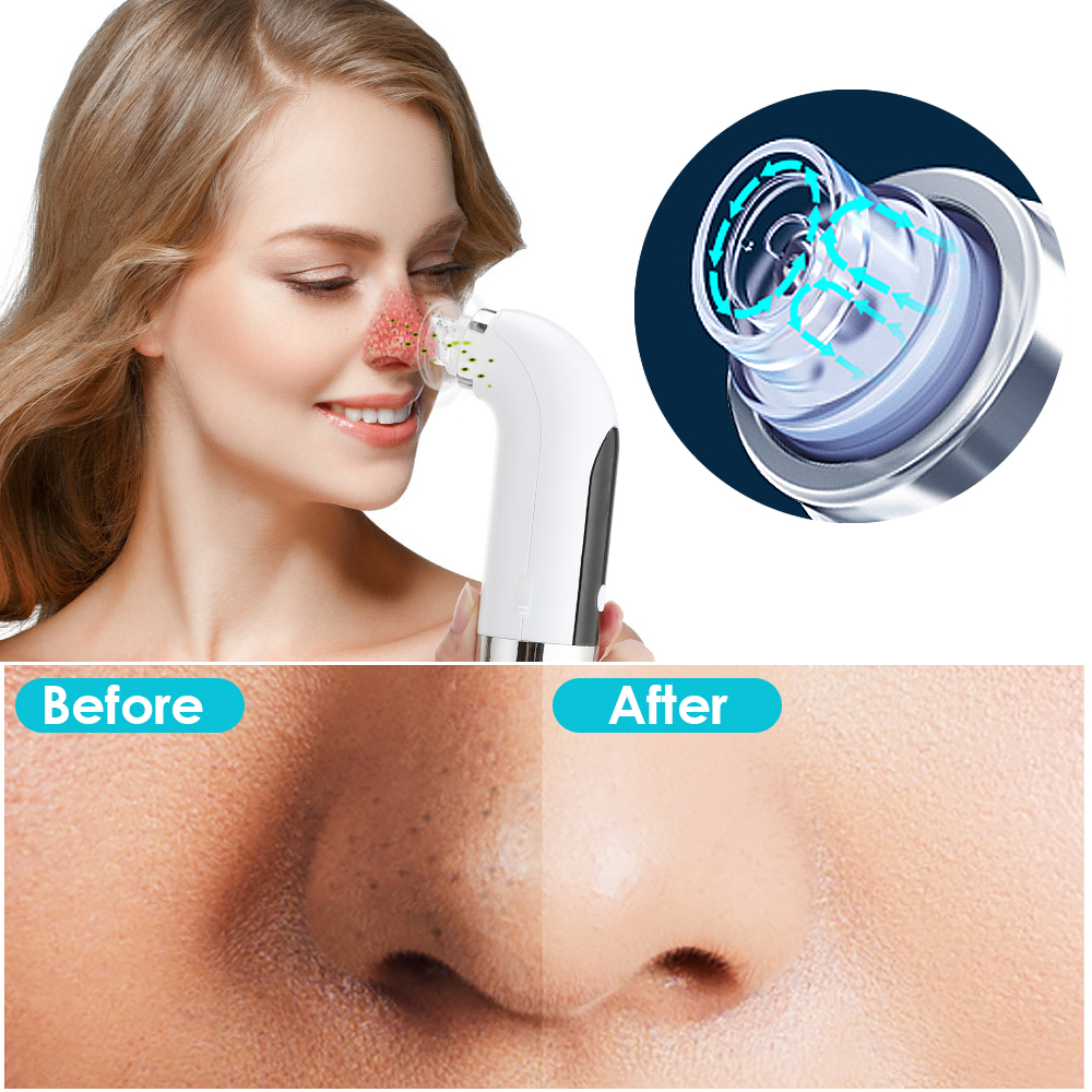 Acne Blackhead Suction Tool With Water tank to Clean Pore Vacuum Cleaner Water Cycle Blackhead Absorption Beauty Device