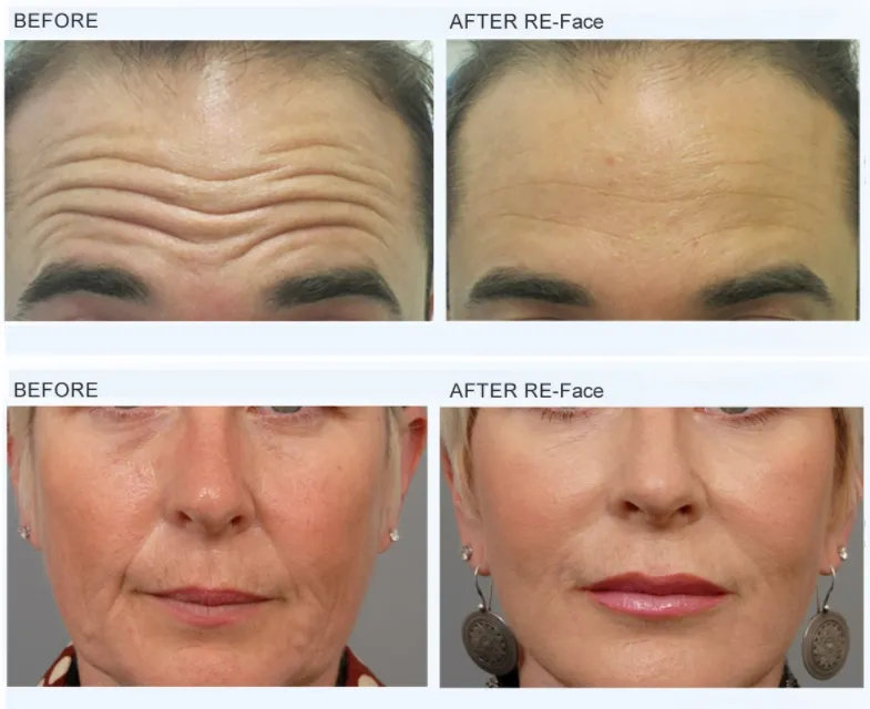 Before and After Results
