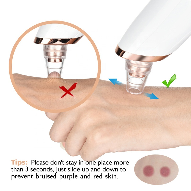 Blackhead Remover 7