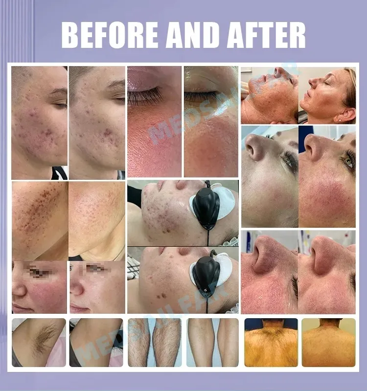 Before and After Treatment