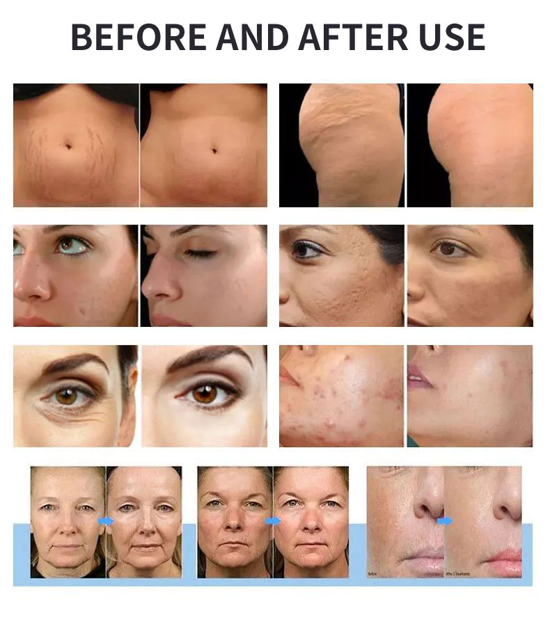 Trending Product 2026 RF Microneedling Machine Stretch Mark Removal Wrinkle Removal AntiAging Skin Rejuvenation Beauty Equipment