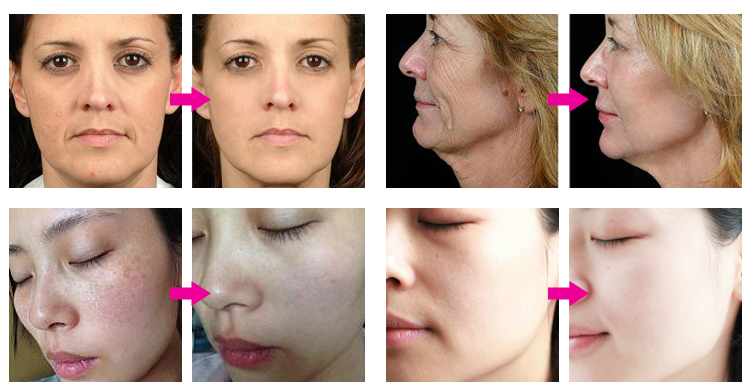 Before and After Results