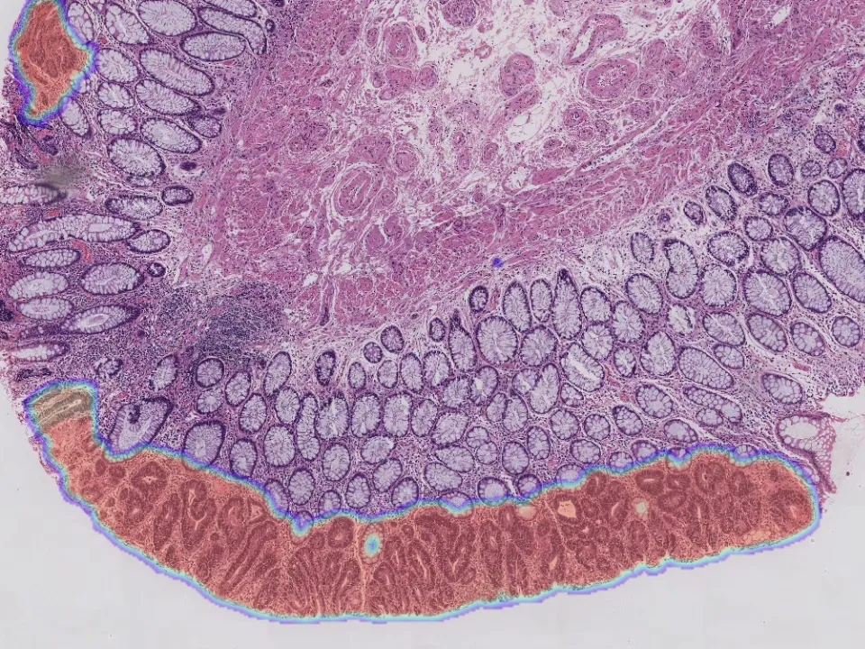Intestinal Biopsy