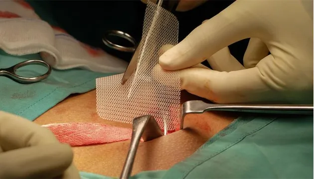 Hernia Mesh Detail 3