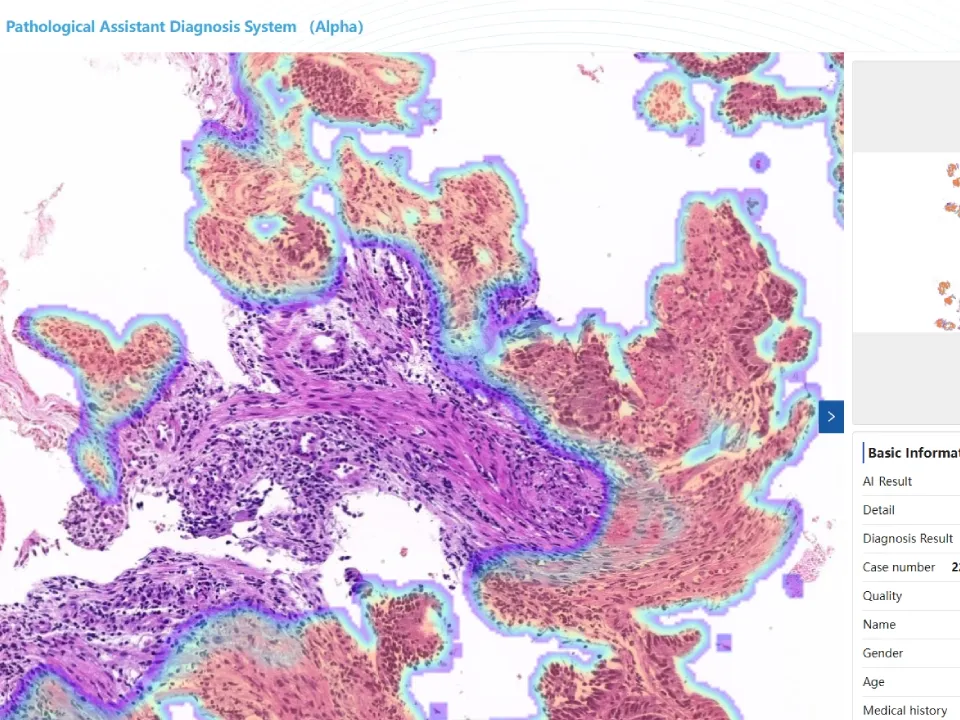 Hydrothorax Analysis