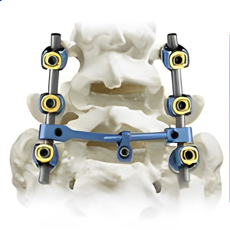 Polyaxial Spine Titanium Pedicle Screws 5.5 System Orthopedic Implants Instruments for Spinal Surgery Bone Implants Hospitals