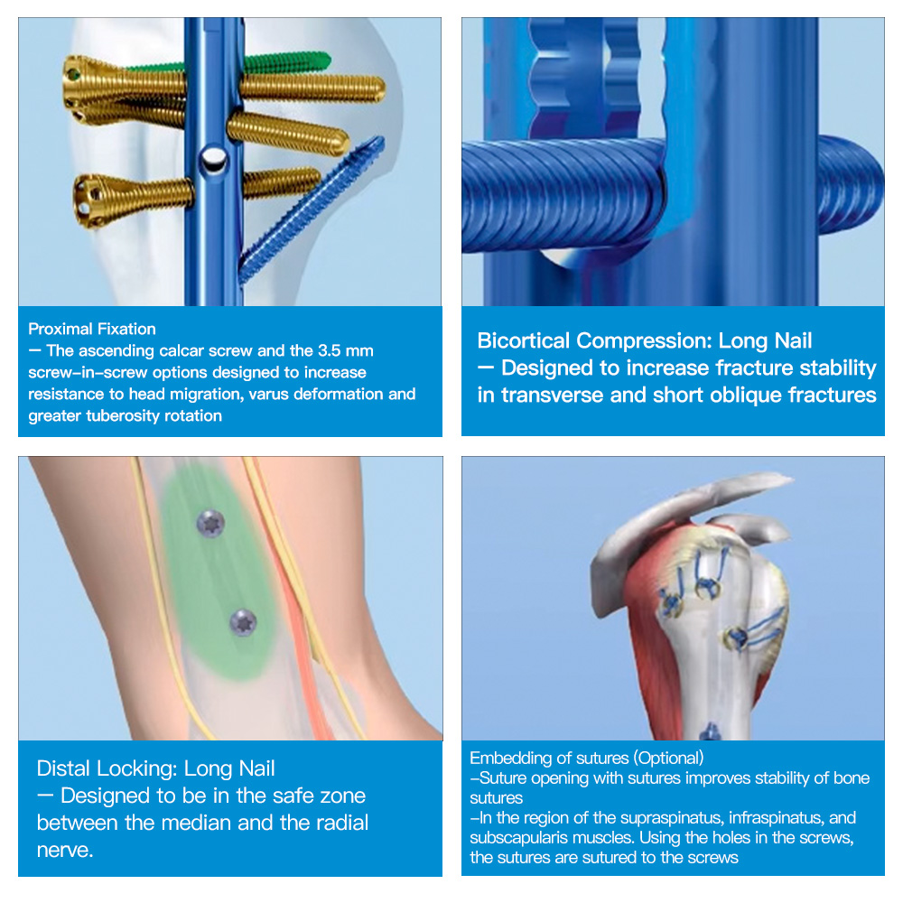 Geasure Stock Orthopedic Surgical Humeral Nail for Osteoporotic Bone Fixation Medical Orthopedic