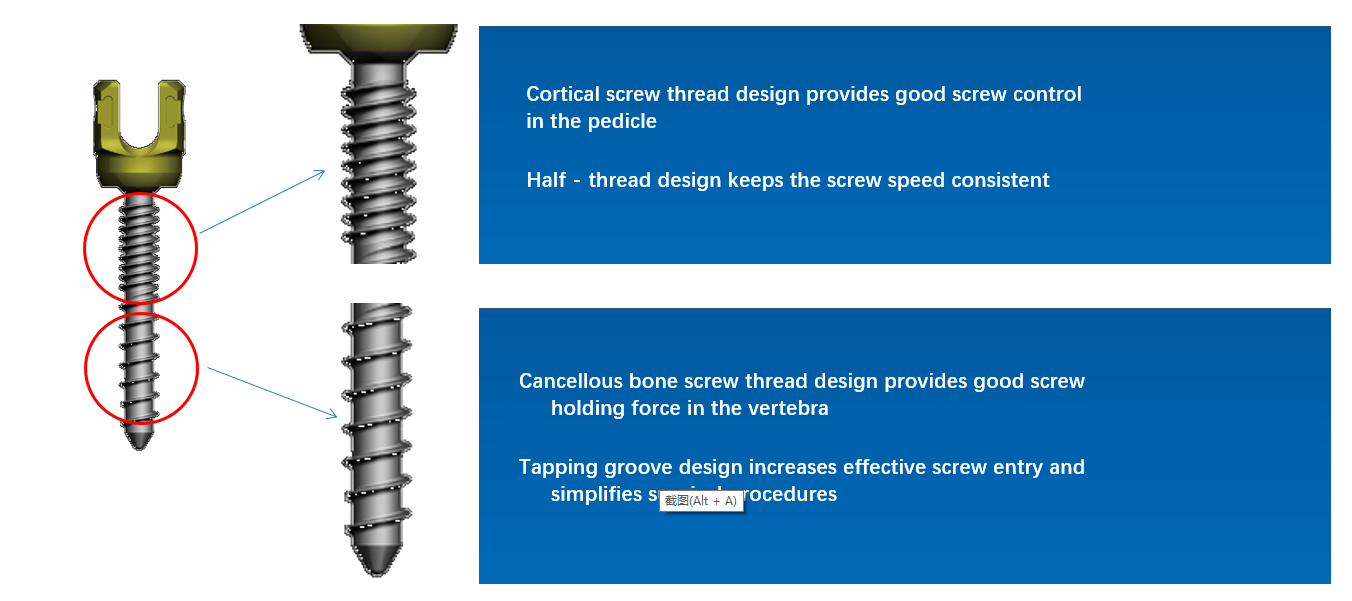 Geasure Low Price Trauma Orthopedics Spine Screws Internal Fixation System Orthopedic Implants Titanium Alloy Dual Thread