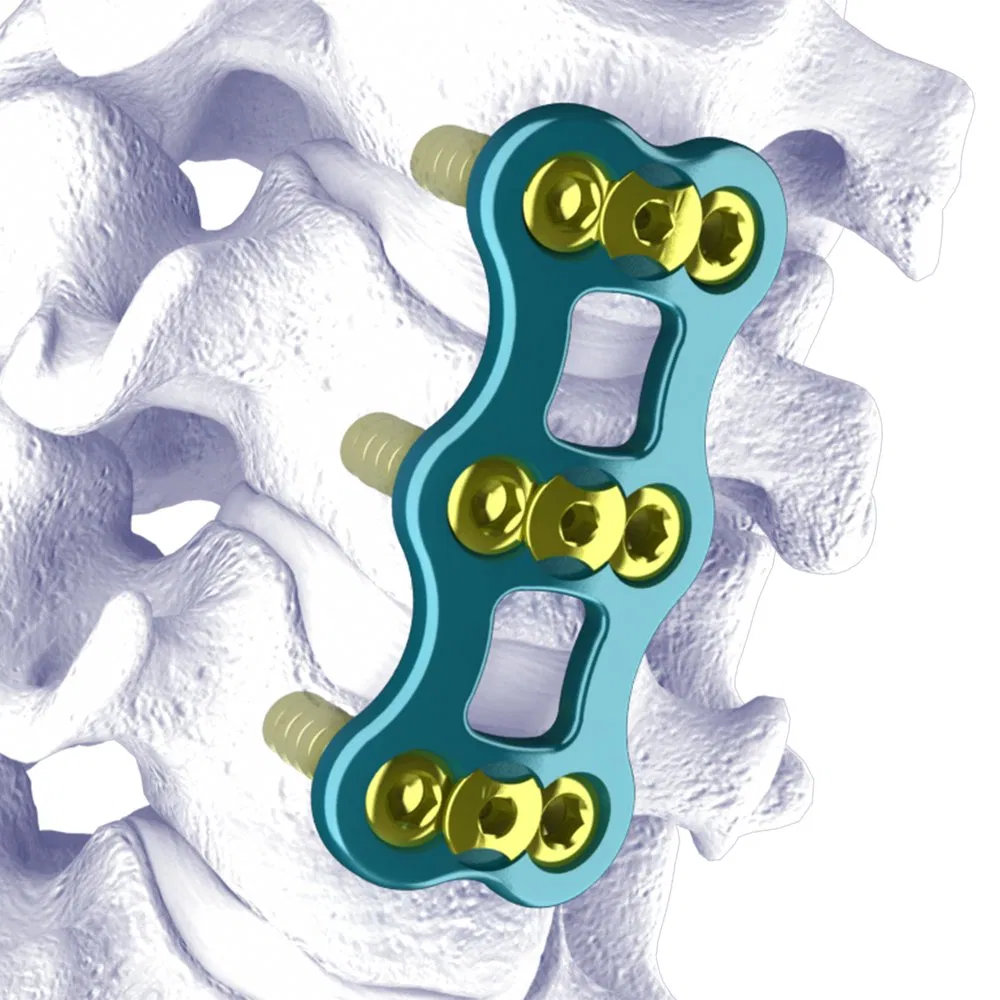 Disposable Surgical Neulen Laminoplasty Inter Pedicle Screw Orthopaedic Instrument Bone Graft Implant Walen Anterior Cervical Plate System