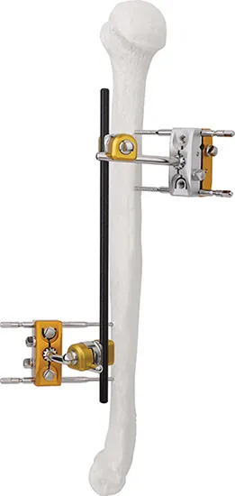 Humeral Shaft Fixator