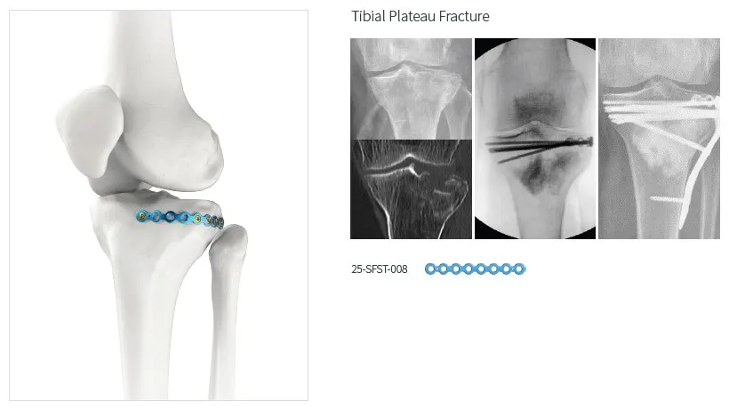 Trauma Plate System 4