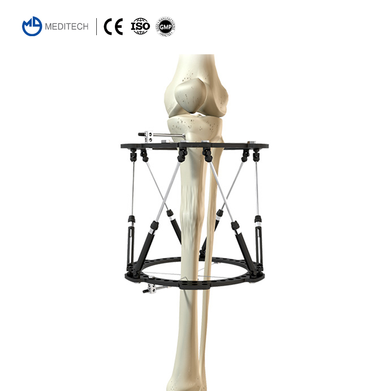 External Fixator Orthopedic Instruments Ilizarov Fixation System Lower Limb Lengthening