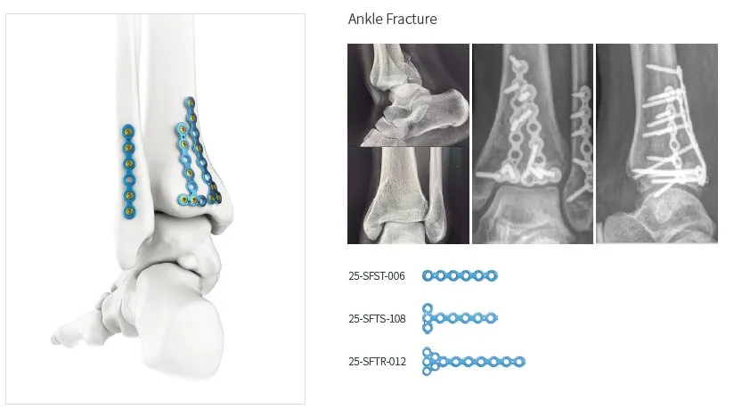 Trauma Plate System 5