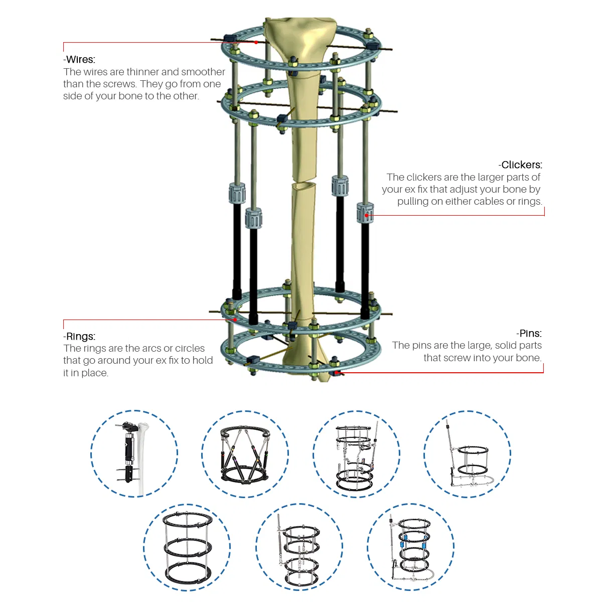 Hot Selling Othropedics Surgery Bone Correction Fracture Surgery External Fixation System
