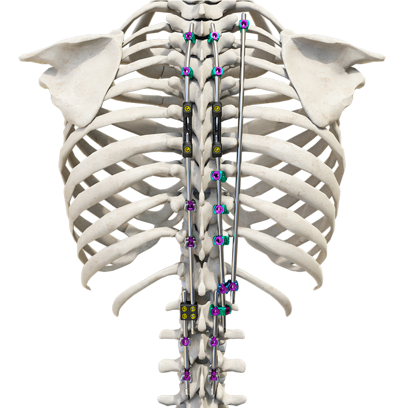 Comprehensive Growth Rods and Rigid Stabilization Fixation System