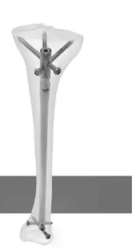 Titaniumtibia Intramedullary/Interlocking Nail System with ISO, CE