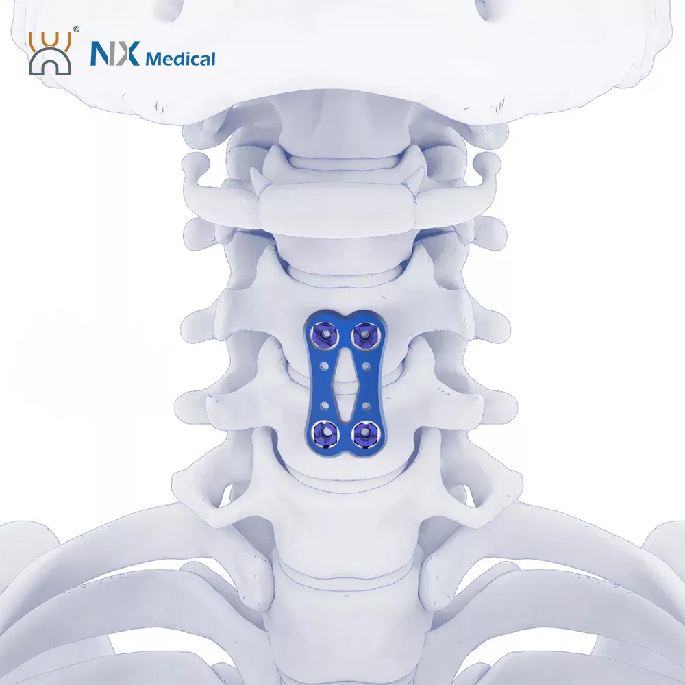 Nx Medical Anterior Cervical Plate System Spine Internal Fixation Titanium China Factory