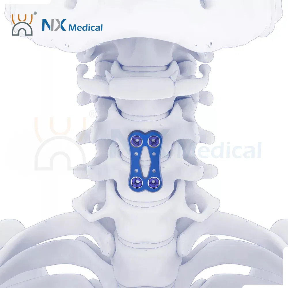 Nx Medical Anterior Cervical Plate System Spine Internal Fixation Titanium OEM ODM